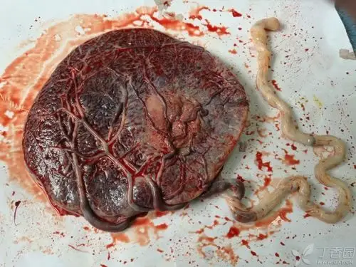 胎盘血池,帆状胎盘