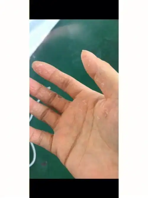 分享一个手癣的中药外洗方