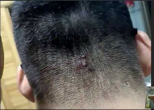 这个包是毛囊炎还是什么