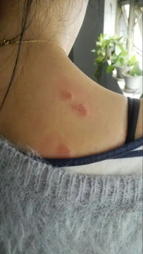 身体各处(背部居多)长了一个圆的坑,很痒,是疮吗