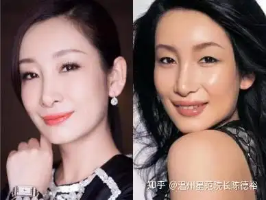 像秦海璐和傅菁,做了双眼皮手术后,在颜值和气质上的变化比单眼皮时期