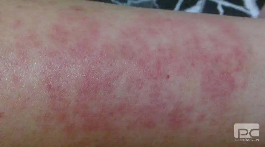 重庆专家解析皮肤过敏应该怎么治疗