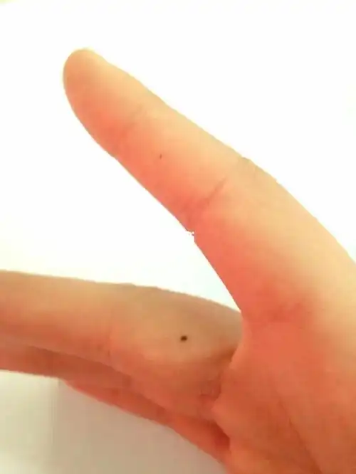 中指长痣意味着什么?_星座_星座命理_星座命理其他