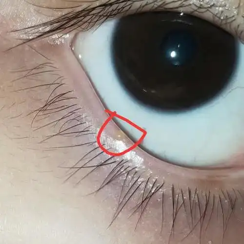 眼睑长了个小包怎么回事?