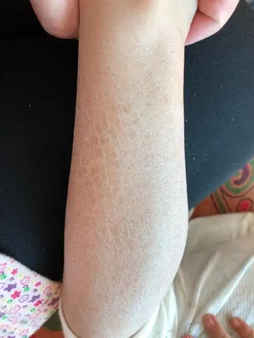 孩子身上皮肤粗糙是什么原因需要治疗吗