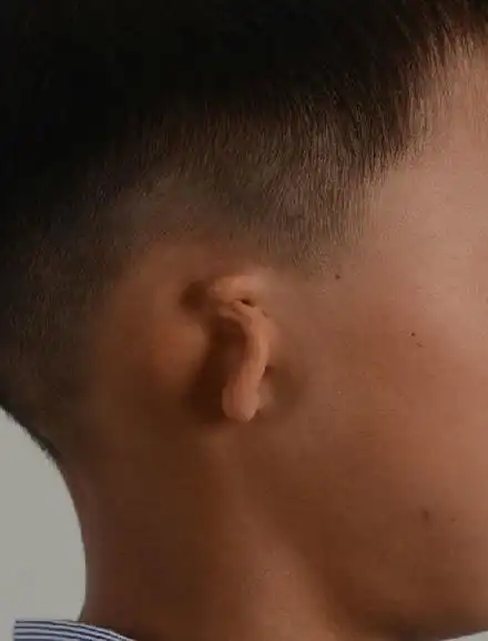 先天性小耳畸形耳再造过程