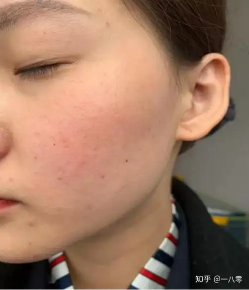 痘痘合并敏感肌如何护肤?