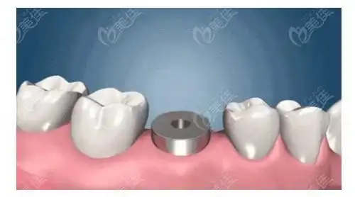 来看看种植牙愈合基台吧