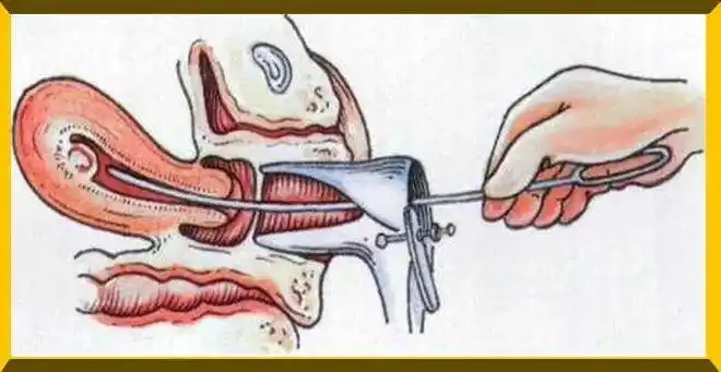 任由医生将冰凉的扩阴器推进阴道,双腿大开,赤裸着横躺在汗湿的病床上