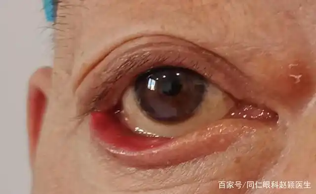 眼睑外翻的手术治疗