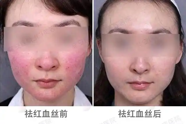 祛红血丝比图