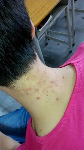 脖子长痘痘长很久了怎么回事