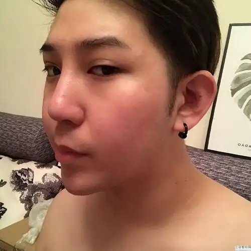 蒜头鼻矫正的费用