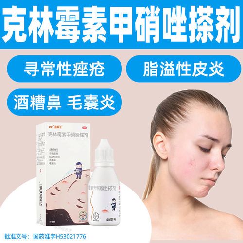 痤康王克林霉素甲硝唑擦剂40ml 寻常痤疮脂溢性皮炎酒糟鼻毛囊炎