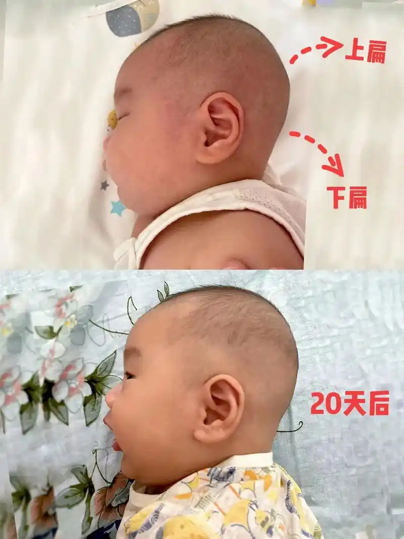 创作灵感 睡圆头|如何纠正枕骨凸出上扁头型73#圆头和扁头  - 抖音