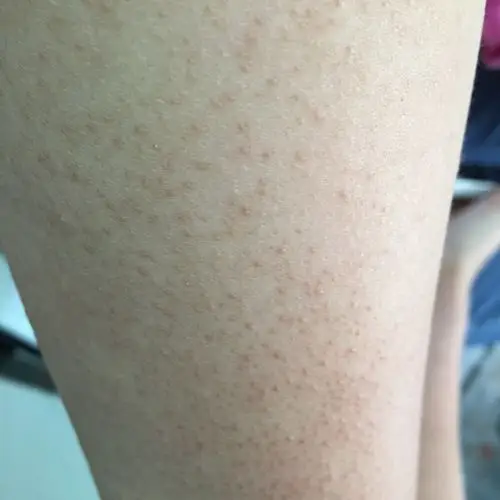 手臂上长了鸡皮肤.请问要怎么才能根治啊?