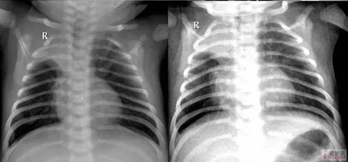 【讨论】两例患儿的胸片
