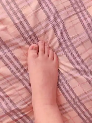 我的大脚趾值得保护吗?又短又翘,翘到45°仰望天.