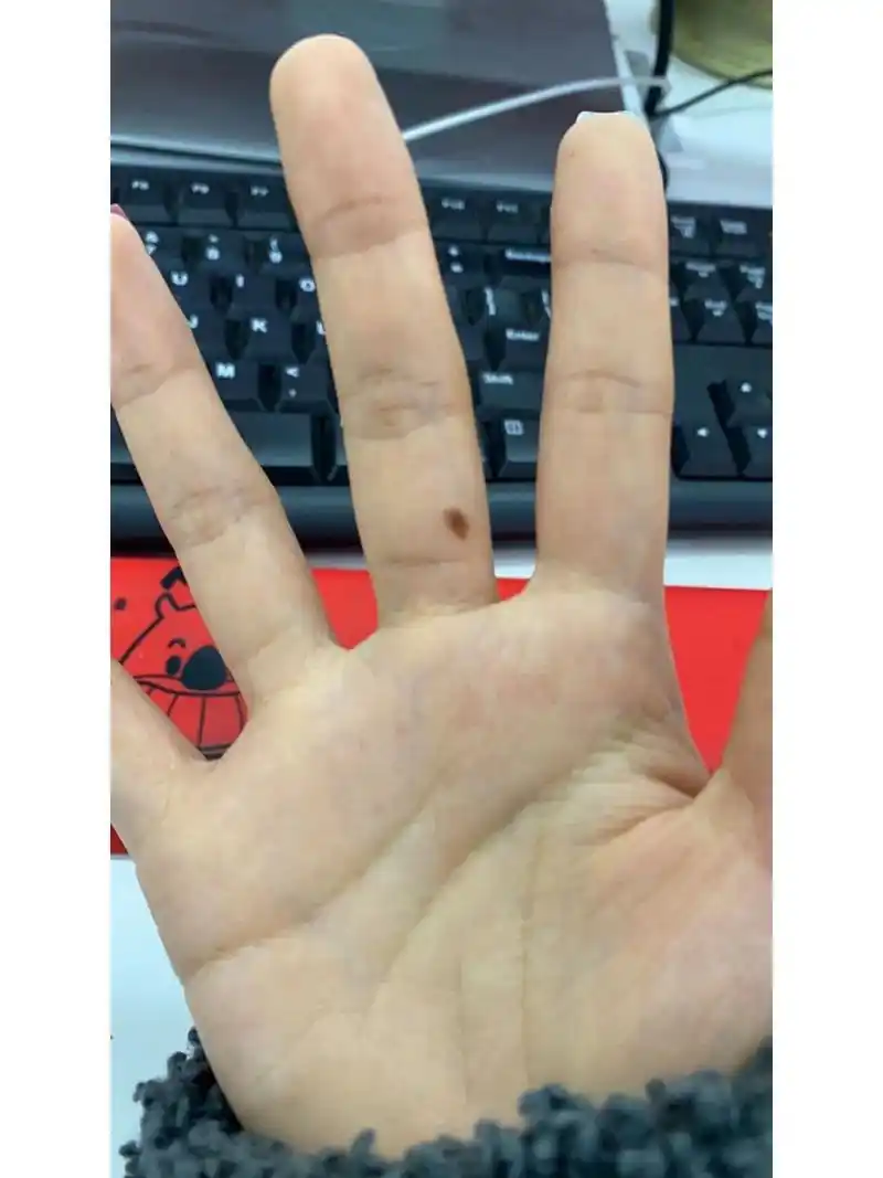 右手中指有痣竟然代表… 右手中指指根有一颗从小到大都在的痣,上班上