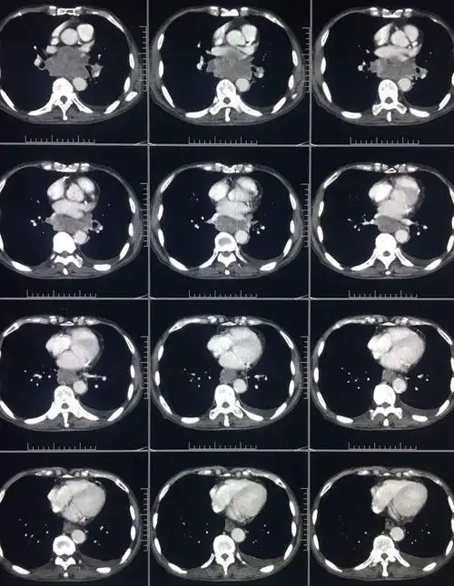 ct平扫 三期增强,这个纵隔占位有点难 [病例帖]