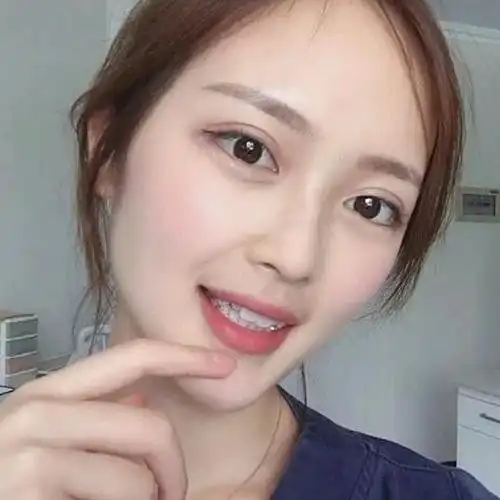 因为虎牙是龅牙,小时候别人都说很可爱,大了就不觉得_圈子-新氧美容