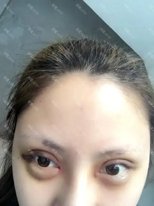 上海同城 | 开内眼角 | 眼部整形 | 开眼角 | 全切开双眼皮 | 双