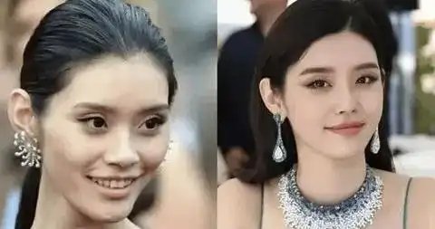 超模奚梦瑶早期的颧骨也很高,但是做完填充后颧骨线条流畅了就会有"好