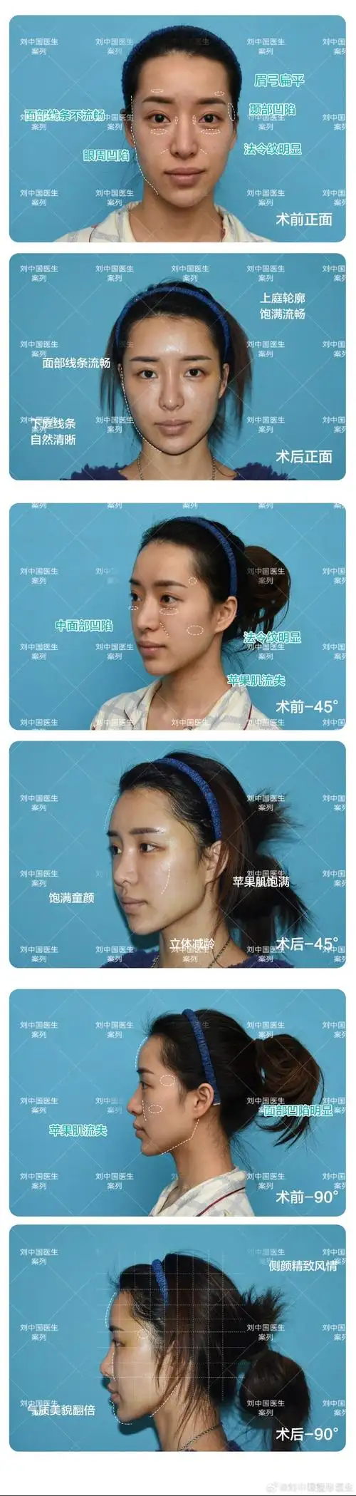 自体脂肪填充面部