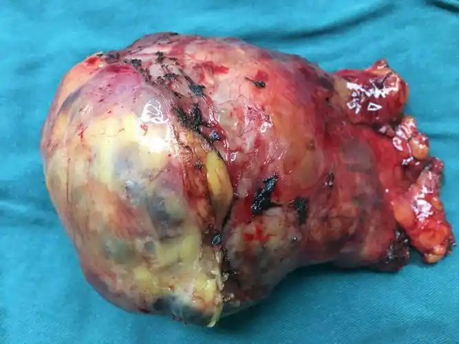 这样的纵隔肿瘤是可以安全切除的