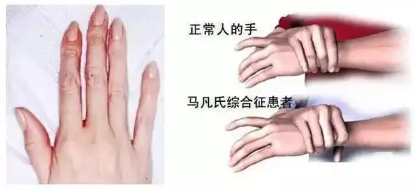 号称"天才病"的马凡氏综合征,究竟是什么?