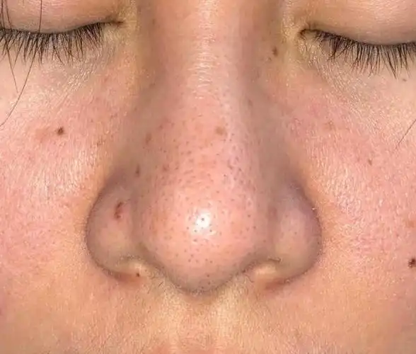 还在"挤黑头"?难怪鼻头越来越大,这几个误区女生一定要知道