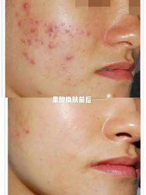 一次果酸换肤能保持效果多久