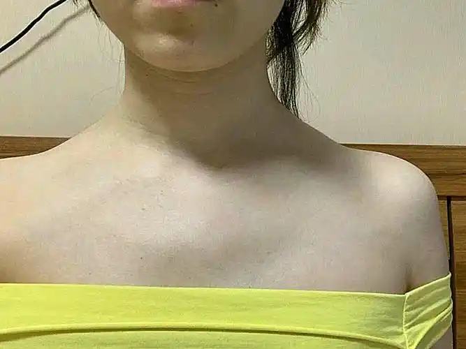 我还是第一次打斜方肌,以前肉毒素不是打瘦脸就是瘦腿_圈子-新氧美容