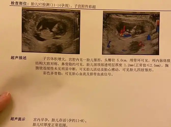 12周nt检查,能看出是男是女不?