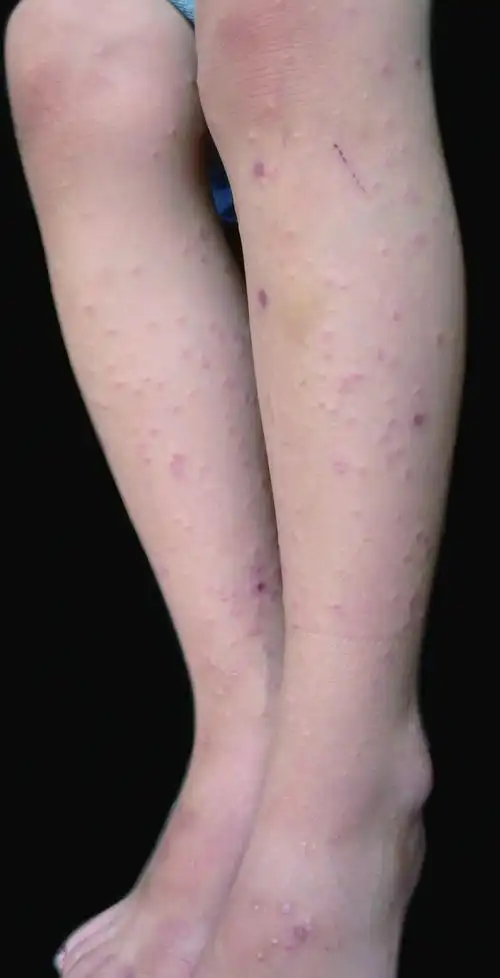 皮肤性病科图谱: 病毒性皮肤病 儿童丘疹性肢端皮炎