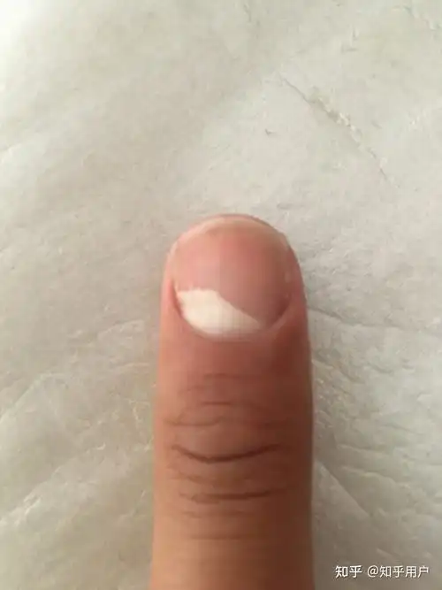 指甲根发白该怎么办呀