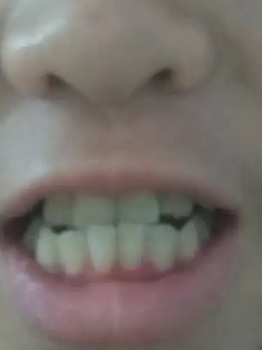 我下牙包上牙,而且还突嘴唇,下牙突出很多,要怎么解决这个问题呢