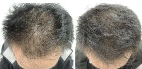 脂溢性皮炎脱发怎么治疗,生发产品哪个效果好