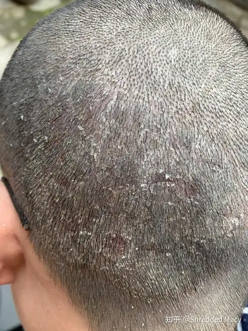 经验帖我是如何治疗头皮癣的