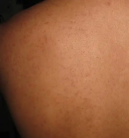 背上长了好多的痘痘,痘痕,有黑头,毛孔很粗.该怎么办,很多