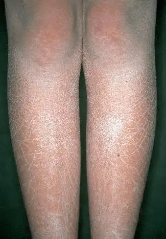 鱼鳞病是一种遗传性角化障碍性皮肤病能根治吗