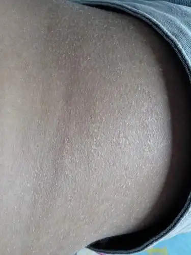 这么看只是皮肤的单纯性干燥,可以使