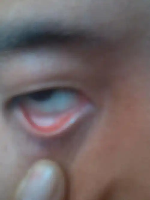 我的眼睛下眼皮内有白色的东西眼睛胀痛眼睛还有点粘我去诊