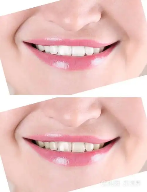 微笑的年轻女子前后牙齿美白程序特写