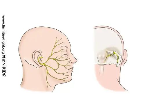 面神经解剖 facial nerve anatomy - 改善听力的治疗 - 手术治疗