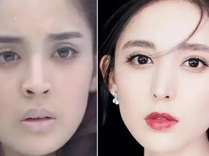 关于鼻翼缩小那些事