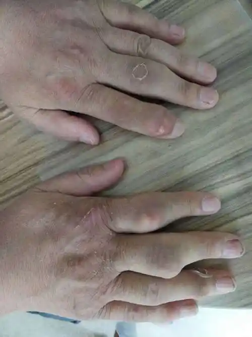 痛风性关节炎 类风湿关节炎