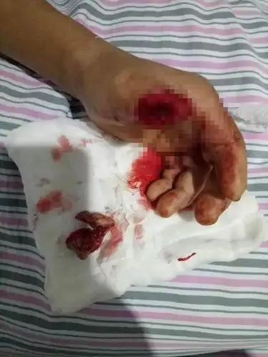 为患者进行了检查,患者大拇指已经完全离断,而且残端又被切成了两份