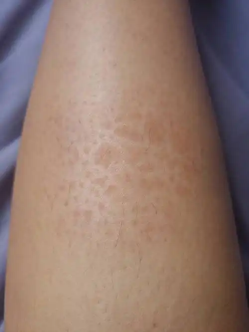 小腿局部发红的蛇皮部分 里面还有小红点 这是什么皮肤病?