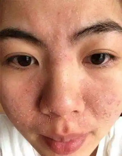 秋冬面部干燥脱皮,易感染螨虫啃食皮脂屑,1方法防螨皮肤滋润